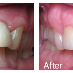 single dental implant before and after