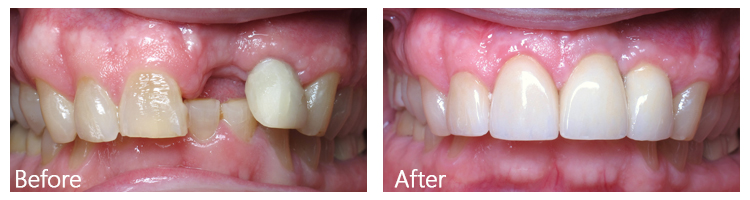 single dental implant before and after