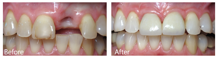 Before & After Photos