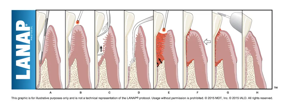 Process of LANAP periodontal surgery